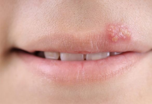 Nicht nur optisch störend: Lippenherpes-Bläschen. Oft sind sie auch mit ausgeprägtem Juckreiz verbunden. Wir geben Tipps, wie Sie Lippenherpes verhindern können.